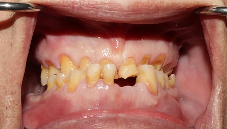 Teeth showing severe crowding before dental treatment