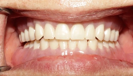 Straightened teeth after dental treatment